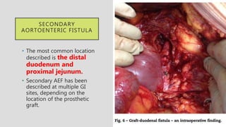 SECONDARY
AORTOENTERIC FISTULA
• The most common location
described is the distal
duodenum and
proximal jejunum.
• Secondary AEF has been
described at multiple GI
sites, depending on the
location of the prosthetic
graft.
 