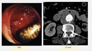 CT scanEGD
 