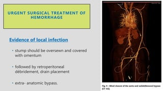 • stump should be oversewn and covered
with omentum
• followed by retroperitoneal
débridement, drain placement
• extra- anatomic bypass.
URGENT SURGICAL TREATMENT OF
HEMORRHAGE
Evidence of local infection
 