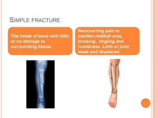 Simple fractureThe break of bone with little or no damage to surrounding tissue.Reoccurring pain to swollen reddish area, bruising , tingling and numbness. Limb or joint weak and displaced. 