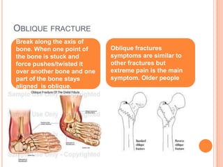 Oblique fractureBreak along the axis of bone. When one point of the bone is stuck and force pushes/twisted it over another bone and one part of the bone stays aligned  is oblique.Oblique fractures symptoms are similar to other fractures but extreme pain is the main symptom. Older people
