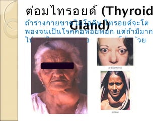 ต่อ มไทรอยด์ (Thyroid
ถ้า ร่า งกายขาดไอโอดีน ไทรอยด์จ ะโต
Gland) แต่ถ ้า มีม าก
พองจนเป็น โรคคอหอยพอก
ไปจะเป็น คอหอยพอกแบบตาโปนด้ว ย

 