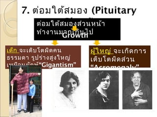 7. ต่อ มใต้ส มอง (Pituitary
ต่อ มใต้สGland) า
มองส่ว นหน้
ทำา งานมากเกิน ไป
Growth

Hormone มาก
เด็ก จะเติบ โตผิด คน
ผูใ หญ่ จะเกิด การ
้
ธรรมดา รูป ร่า งสูง ใหญ่
เติบ โตผิด ส่ว น
เหมือ นยัก ษ์“Gigantism”
“Acromegaly”

 