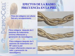 EFECTOS DE LA RADIO
              FRECUENCIA EN LA PIEL

  Fibra de colágeno con efecto
  Del sol y envejecimiento.




Fibra colágena después de 2
sesiones de tratamiento
(mínima inflamación y
generación de neocolágeno).

Fibra colágena después de 5
sesiones de tratamiento con
RF sobre la piel
(mayor inflamación,rotacion por
calor y generación de
neocolágeno).
 