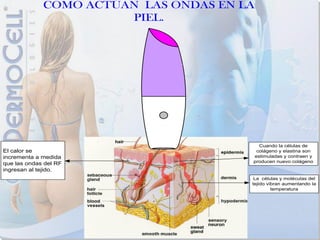COMO ACTÚAN LAS ONDAS EN LA
                       PIEL.




                                         Cuando la células de
El calor se                             colágeno y elastina son
incrementa a medida                    estimuladas y contraen y
                                       producen nuevo colágeno
que las ondas del RF
ingresan al tejido.
                                        La células y moléculas del
                                       tejido vibran aumentando la
                                                temperatura
 