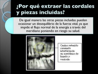 ¿Por qué extraer las cordales y piezas incluidas?  