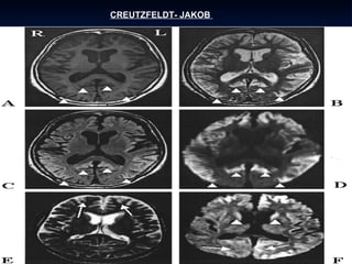 CREUTZFELDT- JAKOB  