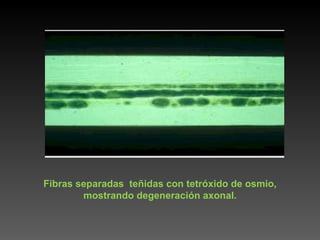 Fibras separadas  teñidas con tetróxido de osmio, mostrando degeneración axonal. 