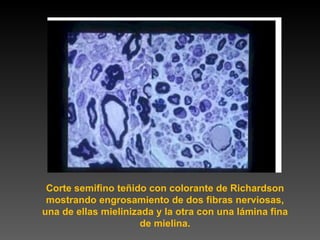 Corte semifino teñido con colorante de Richardson mostrando engrosamiento de dos fibras nerviosas, una de ellas mielinizada y la otra con una lámina fina de mielina. 
