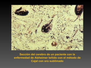 Sección del cerebro de un paciente con la enfermedad de Alzheimer teñido con el método de Cajal con oro sublimado 