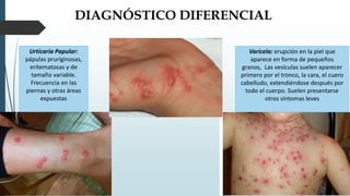 DIAGNÓSTICO DIFERENCIAL
Urticaria Papular:
pápulas pruriginosas,
eritematosas y de
tamaño variable.
Frecuencia en las
piernas y otras áreas
expuestas
Varicela: erupción en la piel que
aparece en forma de pequeños
granos, Las vesículas suelen aparecer
primero por el tronco, la cara, el cuero
cabelludo, extendiéndose después por
todo el cuerpo. Suelen presentarse
otros síntomas leves
 