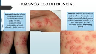 DIAGNÓSTICO DIFERENCIAL
Dermatitis Atópica: afecta
fundamentalmente las
superficies flexoras de
codos y rodillas.
Enrojecimiento o
inflamación de la piel
alrededor de las ampollas.
Impétigo: Iinfección es secundaria
a otras enfermedades cutáneas
subyacentes que afectan la barrera
cutánea, vesículas o ampollas en la
piel, las lesiones son más
frecuentes en cara. no bulloso y
bulloso
 