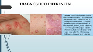 DIAGNÓSTICO DIFERENCIAL
Psoriasis: produce lesiones escamosas
engrosadas e inflamadas, con una amplia
variabilidad clínica y evolutiva. No es
contagiosa, Puede afectar a cualquier
parte de la piel, frecuentemente a las
zonas de codos, rodillas, cuero cabelludo,
abdomen y espalda. pápula o placa
eritematosa, de tamaño diverso y tono
rojo oscuro, bordes delimitados y
habitualmente cubierta de escamas.
 