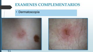 EXAMENES COMPLEMENTARIOS
• Dermatoscopía
 