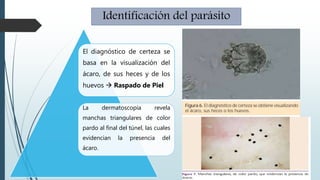 El diagnóstico de certeza se
basa en la visualización del
ácaro, de sus heces y de los
huevos  Raspado de Piel
La dermatoscopía revela
manchas triangulares de color
pardo al final del túnel, las cuales
evidencian la presencia del
ácaro.
Identificación del parásito
 