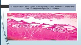 La biopsia cutánea de las pápulas acarinas puede poner de manifiesto la presencia del
túnel subcórneo con el parásito en su interior
 
