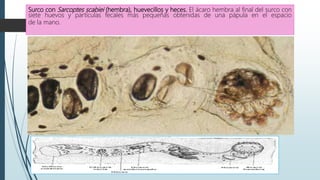 Surco con Sarcoptes scabiei (hembra), huevecillos y heces. El ácaro hembra al final del surco con
siete huevos y partículas fecales más pequeñas obtenidas de una pápula en el espacio
de la mano.
 