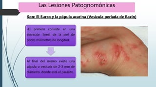 Las Lesiones Patognomónicas
-El primero consiste en una
elevación lineal de la piel de
pocos milímetros de longitud.
Al final del mismo existe una
pápula o vesícula de 2-3 mm de
diámetro, donde está el parásito.
Son: El Surco y la pápula acarina (Vesícula perlada de Bazin)
 