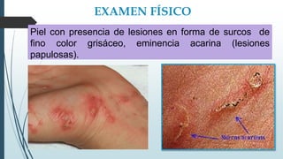 EXAMEN FÍSICO
Piel con presencia de lesiones en forma de surcos de
fino color grisáceo, eminencia acarina (lesiones
papulosas).
 