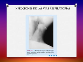 INFECCIONES DE LAS VÍAS RESPIRATORIAS
 