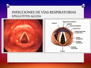 INFECCIONES DE VÍAS RESPIRATORIAS
EPIGLOTITIS AGUDA
 