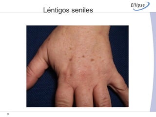 Léntigos seniles 