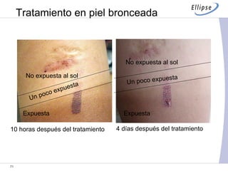 Tratamiento en piel bronceada Expuesta Un poco expuesta No expuesta al sol No expuesta al sol Expuesta Un poco expuesta 10 horas después del tratamiento 4 días después del tratamiento 