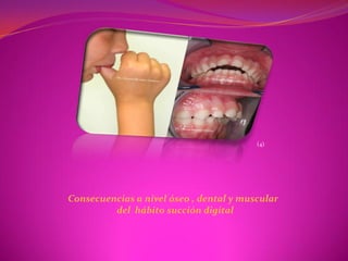 (4)




Consecuencias a nivel óseo , dental y muscular
         del hábito succión digital
 