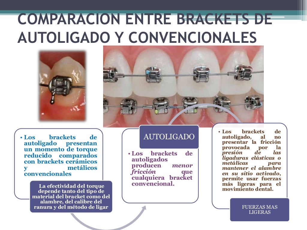 Autoligado activo vs pasivo torque slot anclaje