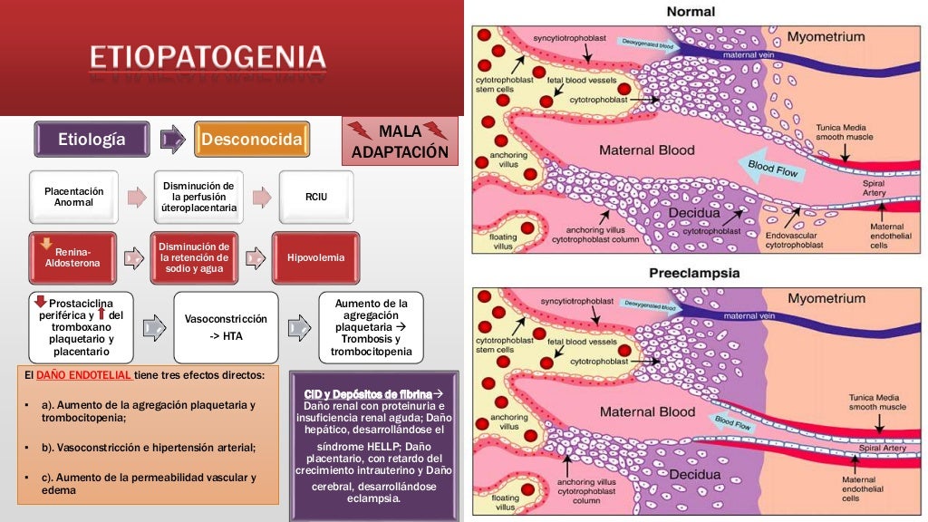 PreeclampsiaEclampsia