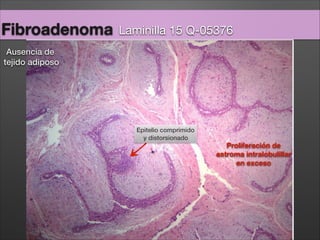 Fibroadenoma Laminilla 15 Q-05376
Proliferación de
estroma intralobulillar
en exceso
Epitelio comprimido
y distorsionado
A...