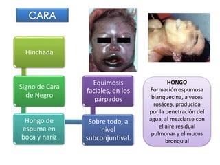 Hinchada
Signo de Cara
de Negro
Hongo de
espuma en
boca y nariz
Sobre todo, a
nivel
subconjuntival.
Equimosis
faciales, en los
párpados
HONGO
Formación espumosa
blanquecina, a veces
rosácea, producida
por la penetración del
agua, al mezclarse con
el aire residual
pulmonar y el mucus
bronquial
 