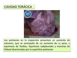 Los pulmones en la inspección presentan un aumento de
volumen, que se acompaña de un aumento de su peso, y
equimosis de Tardieu. Equimosis subpleurales y manchas de
Paltauf diseminadas por la superficie pulmonar.
CAVIDAD TORÁCICA
 
