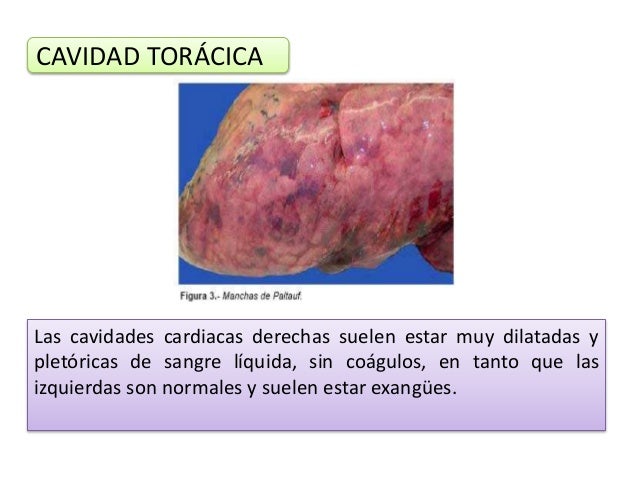 Presentación de asfixia sumersión