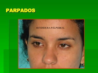 PARPADOS HENDIDURA PALPEBRAL 