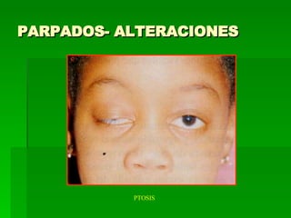 PARPADOS- ALTERACIONES PTOSIS 