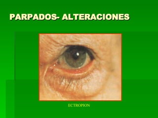 PARPADOS- ALTERACIONES ECTROPION 