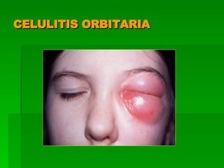 CELULITIS ORBITARIA 