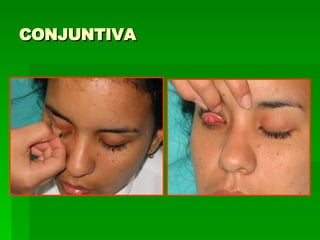 CONJUNTIVA 