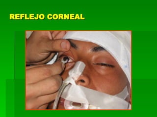 REFLEJO CORNEAL 