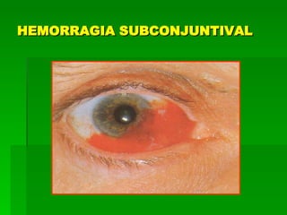 HEMORRAGIA SUBCONJUNTIVAL 