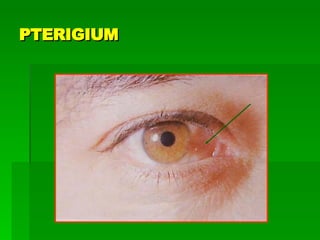PTERIGIUM 