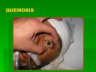 QUEMOSIS 