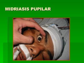 MIDRIASIS PUPILAR 