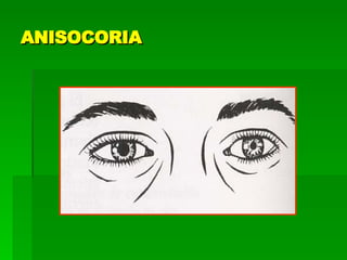 ANISOCORIA 