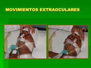 MOVIMIENTOS EXTRAOCULARES 