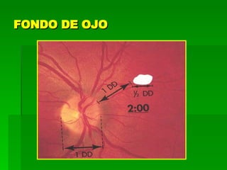 FONDO DE OJO 