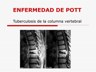 ENFERMEDAD DE POTT Tuberculosis de la columna vertebral 