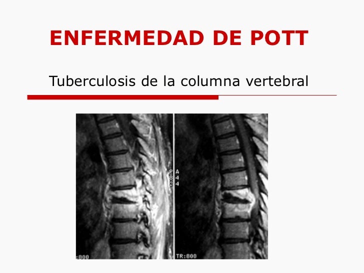 Presentacion Mal De Pott