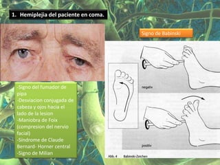 1. Hemiplejia del paciente en coma.


                                      Signo de Babinski




 -Signo del fumador de
 pipa
 -Desviacion conjugada de
 cabeza y ojos hacia el
 lado de la lesion
 -Maniobra de Foix
 (compresion del nervio
 facial)
 -Síndrome de Claude
 Bernard- Horner central
 -Signo de Milian
 